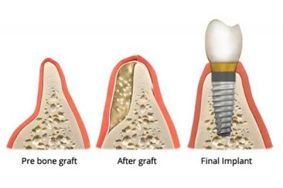 Yetersiz Kemiklerde Greftleme