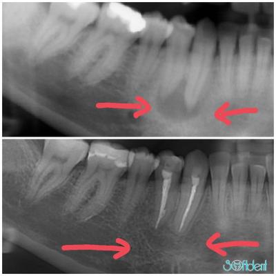Ağız, Çene, Yüz Kist ve Tümörler